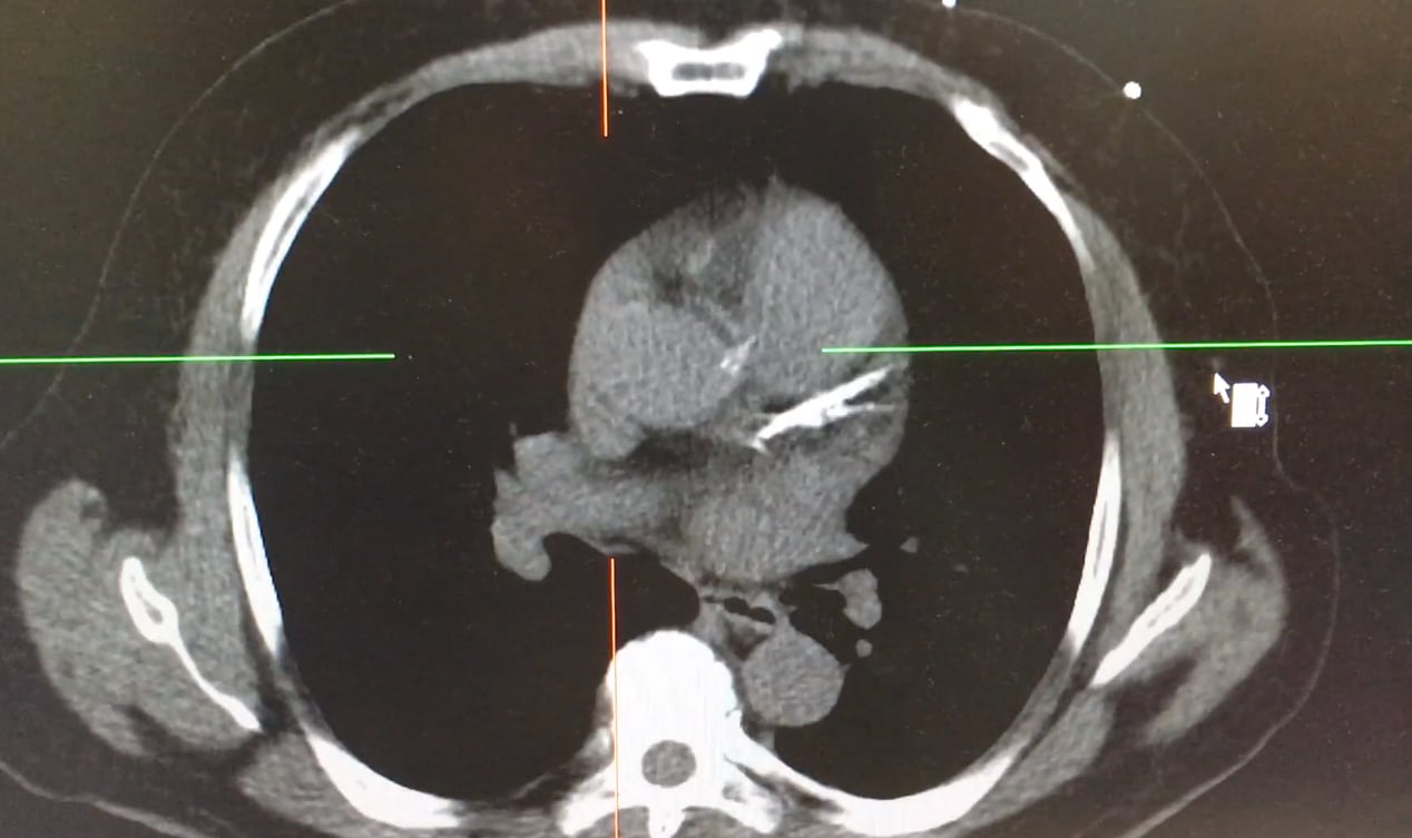 CT Scan For Arterial Plaque is Better at Predicting Heart Attack